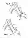 Fig. 05 - Multilumen catheter for minimizing limb ischemia