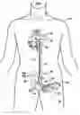 Fig. 01 - Multilumen catheter for minimizing limb ischemia