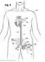 Fig. 04 - Multilumen catheter for minimizing limb ischemia
