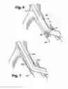 Fig. 05 - Multilumen catheter for minimizing limb ischemia