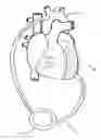 Fig. 01 - Implantable heart assist system and method of applying same