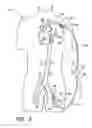 Fig. 06 - Implantable heart assist system and method of applying same