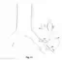 Fig. 11 - Implantable heart assist system and method of applying same