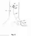 Fig. 12 - Implantable heart assist system and method of applying same