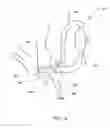 Fig. 16 - Implantable heart assist system and method of applying same