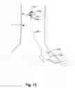 Fig. 12 - Implantable heart assist system and method of applying same