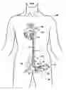 Fig. 01 - Multilumen catheter for minimizing limb ischemia