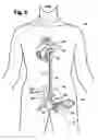 Fig. 04 - Multilumen catheter for minimizing limb ischemia