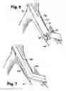 Fig. 05 - Multilumen catheter for minimizing limb ischemia