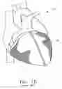 Fig. 03 - Method and device for deployment of a sub-pericardial sack
