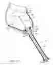 Fig. 15 - Method and device for deployment of a sub-pericardial sack