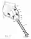 Fig. 16 - Method and device for deployment of a sub-pericardial sack