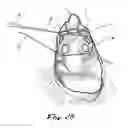 Fig. 06 - Apparatus and methods for performing ablation