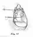 Fig. 09 - Apparatus and methods for performing ablation