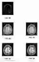 Fig. 06 - Methods and systems to segment central sulcus and Sylvian fissure