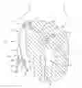 Fig. 01 - Dialysis catheter