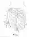 Fig. 02 - Dialysis catheter