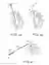 Fig. 17 - Dialysis catheter