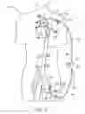 Fig. 07 - Cannulae having a redirecting tip