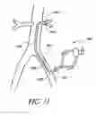 Fig. 12 - Cannulae having a redirecting tip