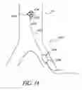 Fig. 15 - Cannulae having a redirecting tip