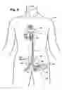 Fig. 04 - Multilumen catheter for minimizing limb ischemia