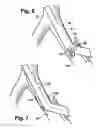 Fig. 05 - Multilumen catheter for minimizing limb ischemia