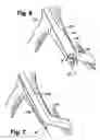 Fig. 05 - Multilumen catheter for minimizing limb ischemia