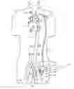 Fig. 01 - Cannulae having a redirecting tip