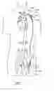 Fig. 04 - Cannulae having a redirecting tip