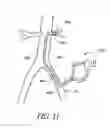 Fig. 12 - Cannulae having a redirecting tip