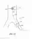 Fig. 15 - Cannulae having a redirecting tip