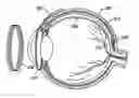 Fig. 01 - Transretinal implant and method of manufacture