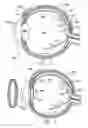 Fig. 03 - Transretinal implant and method of manufacture