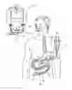 Fig. 01 - Method and apparatus for suctioning and refeeding gastric juices