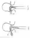Fig. 04 - Expandable esophageal access device