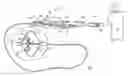 Fig. 01 - Compliant balloon catheter