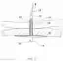 Fig. 04 - Gastric fastening system