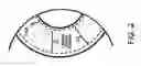 Fig. 03 - Methods for treating eye conditions