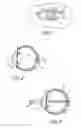 Fig. 02 - Method and apparatus for aligning a mask with the visual axis of an eye