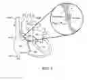 Fig. 02 - Methods and electrode apparatus to achieve a closure of a layered tissue defect