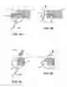 Fig. 05 - Methods and electrode apparatus to achieve a closure of a layered tissue defect