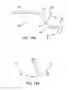 Fig. 17 - Methods and electrode apparatus to achieve a closure of a layered tissue defect