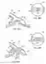 Fig. 28 - Methods and electrode apparatus to achieve a closure of a layered tissue defect