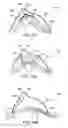 Fig. 31 - Methods and electrode apparatus to achieve a closure of a layered tissue defect
