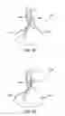 Fig. 46 - Methods and electrode apparatus to achieve a closure of a layered tissue defect