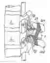 Fig. 01 - Interlaminar vertebral prosthesis