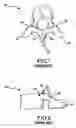 Fig. 02 - Pedicle screw based vertebral body stabilization apparatus