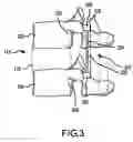 Fig. 03 - Pedicle screw based vertebral body stabilization apparatus