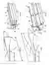 Fig. 05 - Fixation device for bones